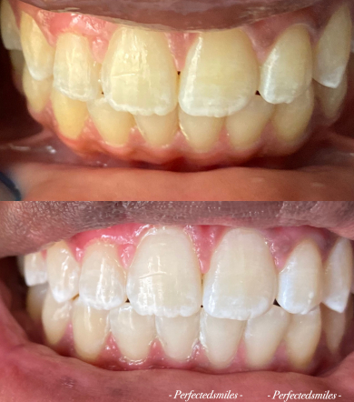 Classes for PerfectedSmile